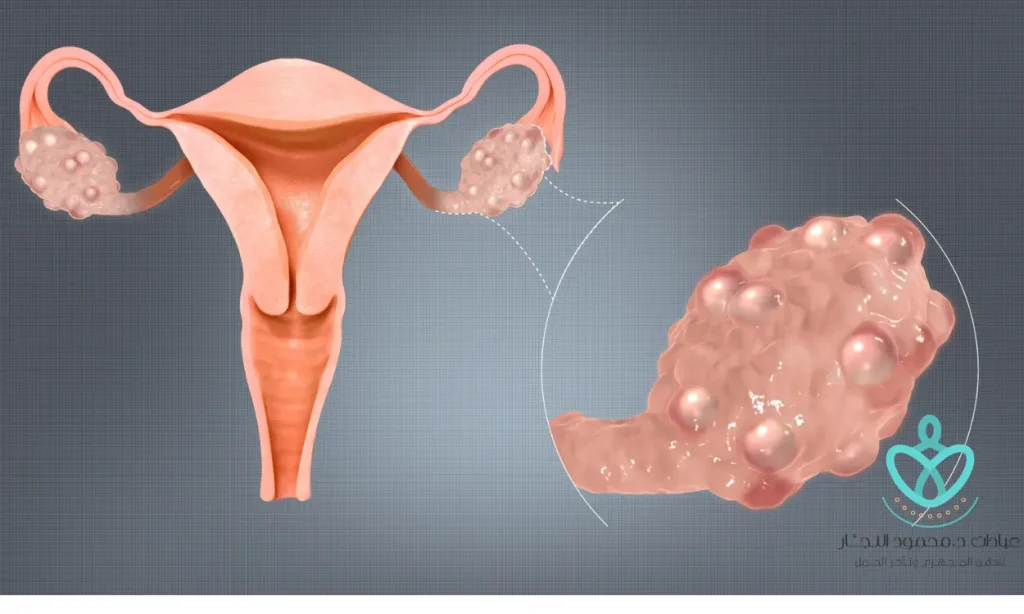 كيف اعرف ان عندي تكيس مبايض​