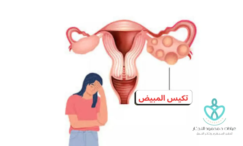 علاج تكيس المبايض البسيط