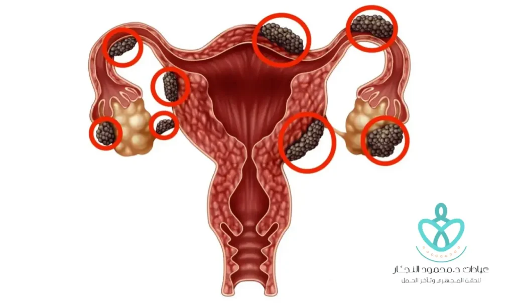 ما هو علاج بطانة الرحم المهاجرة​