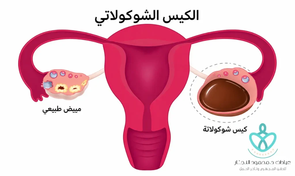 كيس شوكولاتة على المبيض